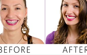 braces-before-and-after-promote-your-dental-practice-with-tiktok-Dental-Marketing-Heroes